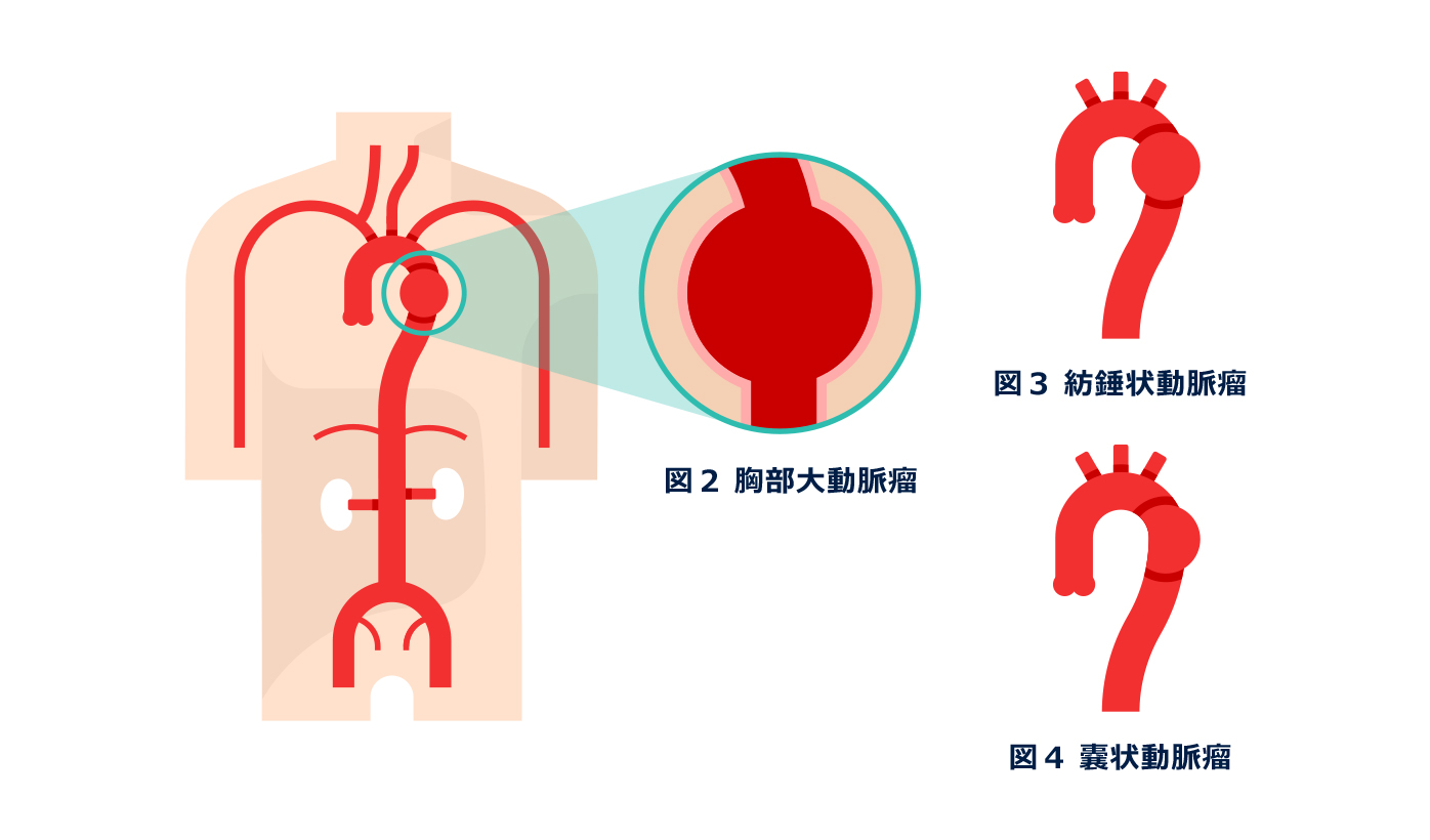 大動脈 解離 退院 後 の 生活